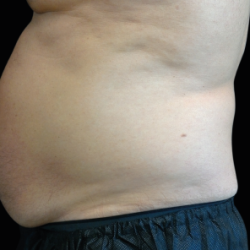 Emsculpt Neo Before & After Patient #7482