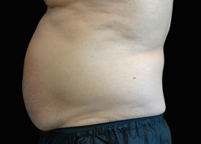 Emsculpt Neo Before & After Patient #7482