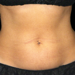 Emsculpt Neo Before & After Patient #7515