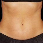 Emsculpt Neo Before & After Patient #7515