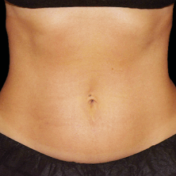Emsculpt Neo Before & After Patient #7515