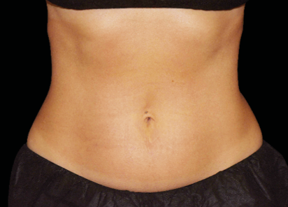 Emsculpt Neo Before & After Patient #7515