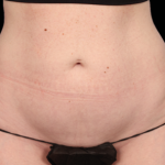 Emsculpt Neo Before & After Patient #7517