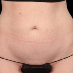Emsculpt Neo Before & After Patient #7517
