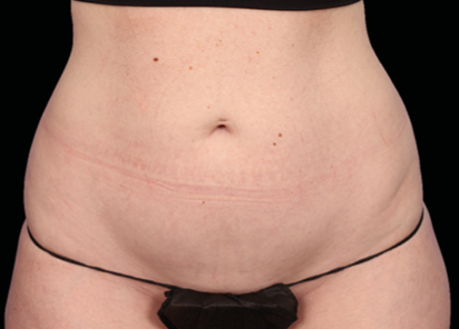 Emsculpt Neo Before & After Patient #7517