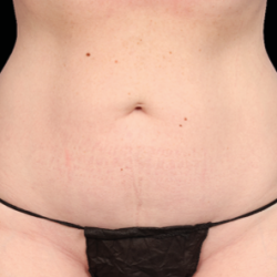 Emsculpt Neo Before & After Patient #7517