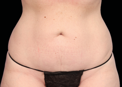 Emsculpt Neo Before & After Patient #7517