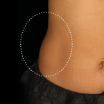 Emsculpt Neo Before & After Patient #7519