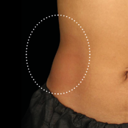 Emsculpt Neo Before & After Patient #7519