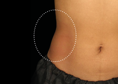 Emsculpt Neo Before & After Patient #7519