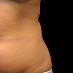 Emsculpt Neo Before & After Patient #7521
