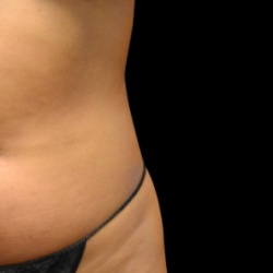 Emsculpt Neo Before & After Patient #7521