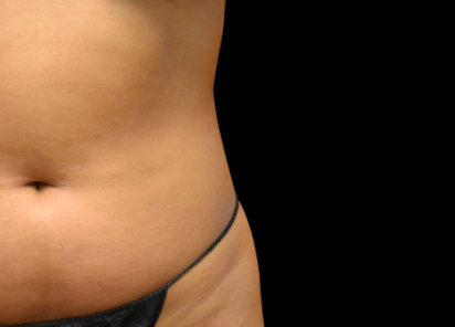 Emsculpt Neo Before & After Patient #7521