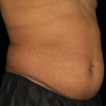 Emsculpt Neo Before & After Patient #7523