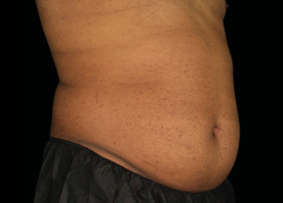 Emsculpt Neo Before & After Patient #7523