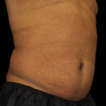 Emsculpt Neo Before & After Patient #7523