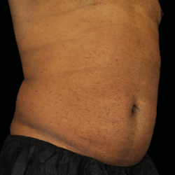 Emsculpt Neo Before & After Patient #7523