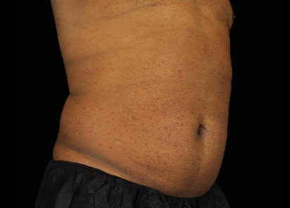 Emsculpt Neo Before & After Patient #7523