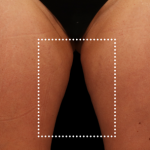 Emsculpt Neo Before & After Patient #7524