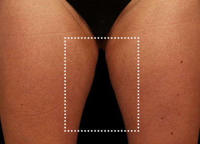 Emsculpt Neo Before & After Patient #7524