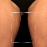 Emsculpt Neo Before & After Patient #7524