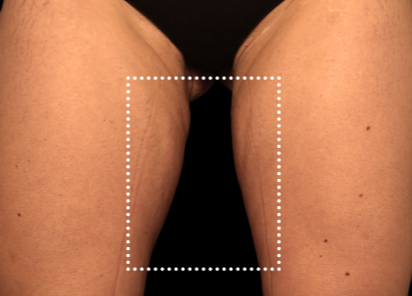 Emsculpt Neo Before & After Patient #7524