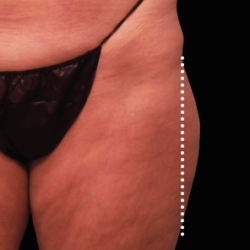 Emsculpt Neo Before & After Patient #7526