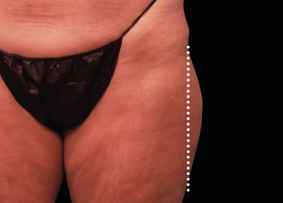 Emsculpt Neo Before & After Patient #7526