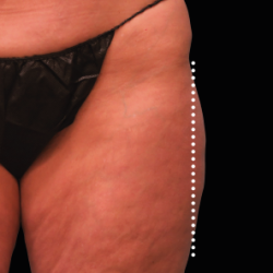 Emsculpt Neo Before & After Patient #7526