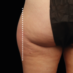 Emsculpt Neo Before & After Patient #7528