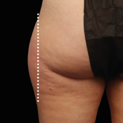 Emsculpt Neo Before & After Patient #7528