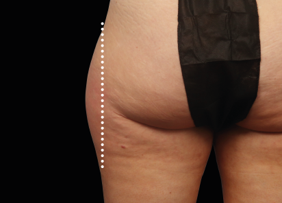 Emsculpt Neo Before & After Patient #7528