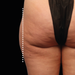 Emsculpt Neo Before & After Patient #7528
