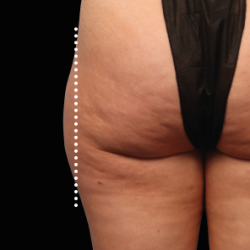Emsculpt Neo Before & After Patient #7528