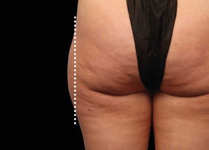 Emsculpt Neo Before & After Patient #7528