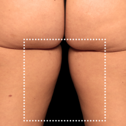 Emsculpt Neo Before & After Patient #7529
