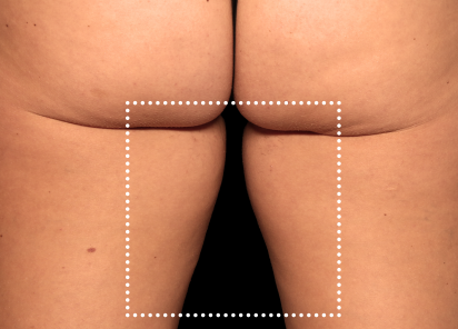 Emsculpt Neo Before & After Patient #7529