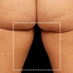 Emsculpt Neo Before & After Patient #7529