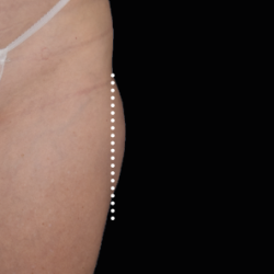 Emsculpt Neo Before & After Patient #7531