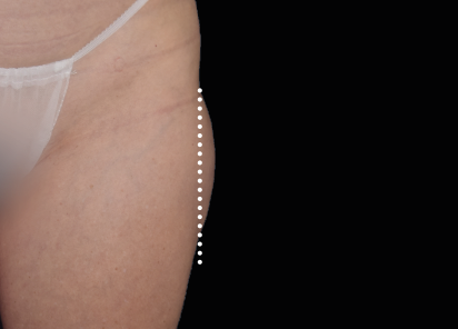 Emsculpt Neo Before & After Patient #7531