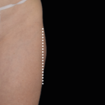 Emsculpt Neo Before & After Patient #7531