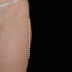 Emsculpt Neo Before & After Patient #7531