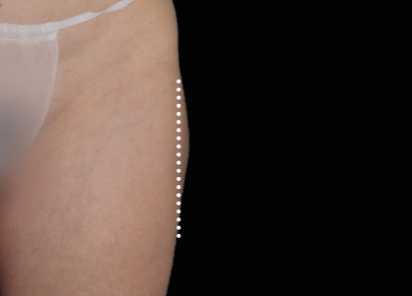 Emsculpt Neo Before & After Patient #7531