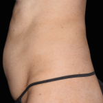 Emsculpt Neo Before & After Patient #7484
