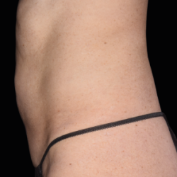 Emsculpt Neo Before & After Patient #7484