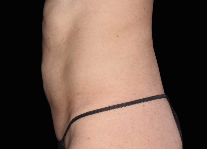 Emsculpt Neo Before & After Patient #7484