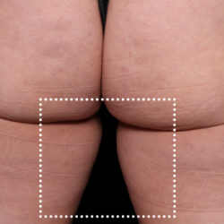 Emsculpt Neo Before & After Patient #7533