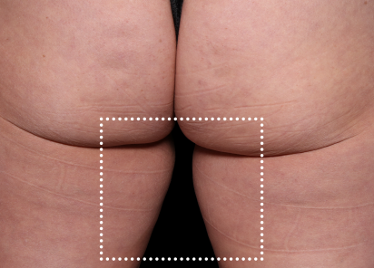 Emsculpt Neo Before & After Patient #7533