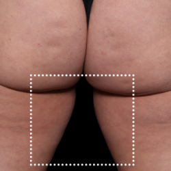 Emsculpt Neo Before & After Patient #7533