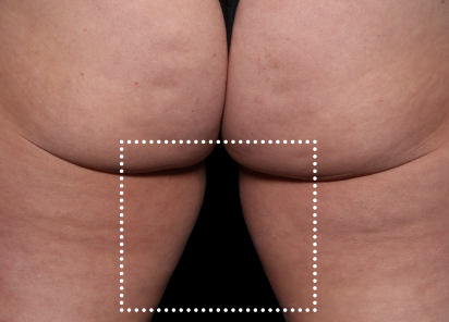 Emsculpt Neo Before & After Patient #7533